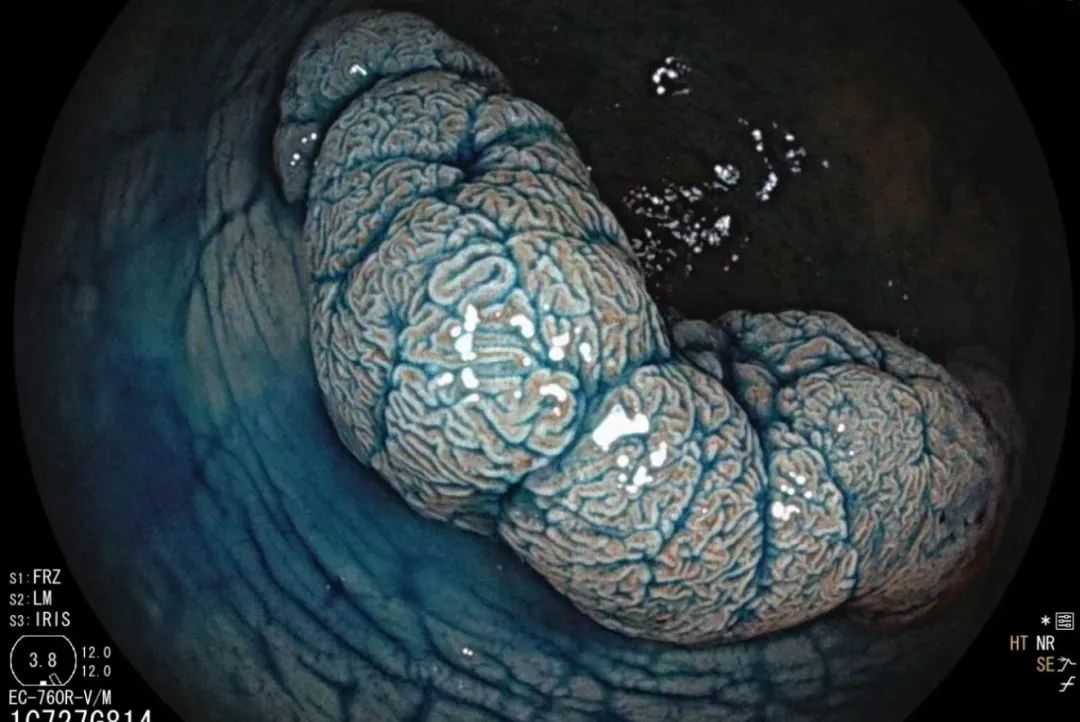 【围观】肠癌高发且年轻化,有这些症状要当心!(图3) 1.jpg