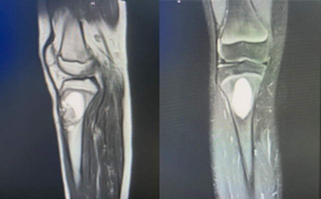 【围观】16岁少年腿痛,一查是肿瘤!(图3) 3.jpg