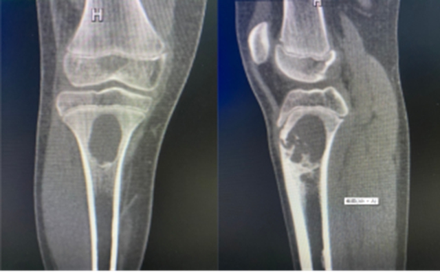 【围观】16岁少年腿痛,一查是肿瘤!(图2) 2.jpg