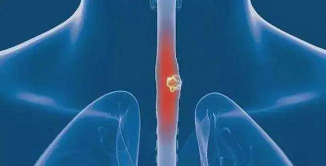 【警惕】这样吃东西，小心食道癌……