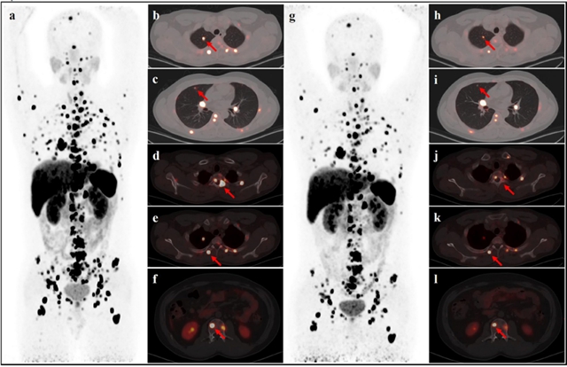 西南医大附院核医学科:国内首例治疗病例,国际首篇相关论文!(图3) 3.jpg