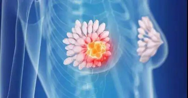 【警惕】15岁女孩乳房不对称,查出10cm肿瘤(图5) 5.jpg