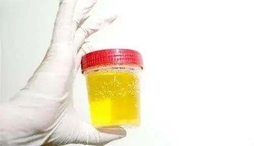 【警惕】小便发黄,是天太热上火了?(图5) 4.jpg