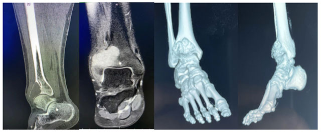【扩散】男子患骨肿瘤,差点截肢?(图2) 2-1.jpg