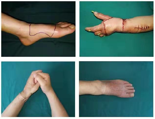 【围观】手指被砍断、绞断、断成几节，我们都可以接！