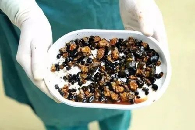 腹痛、恶心、呕吐?可能是结石作祟(图3) 3.jpg