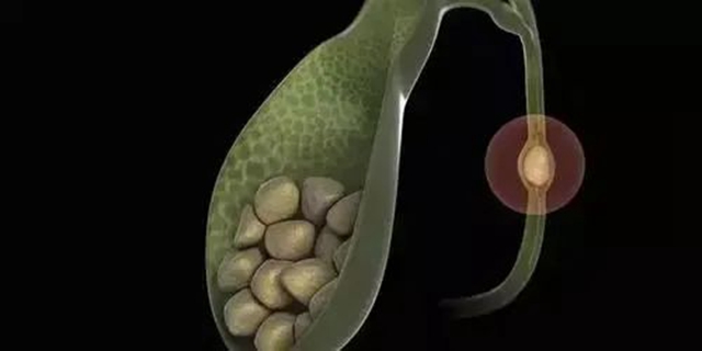 腹痛、恶心、呕吐?可能是结石作祟(图5) 5.jpg