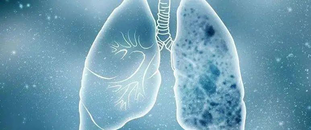 【扩散】最近，很多人非说自己是肺癌？