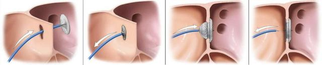 【围观】心累、心慌...竟是因为心脏上有个洞(图4) 1-4.jpg