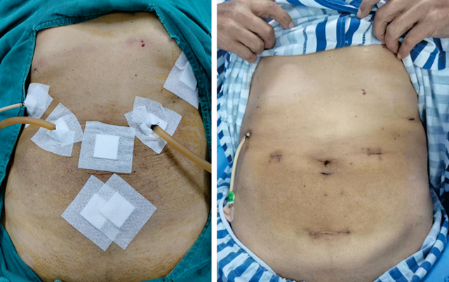 “皇冠手术”不再“开膛破肚”—— 腹腔镜下精准施刀,胰十二指肠完美切除(图3) 3.png