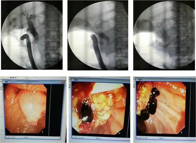 【惊呆】 泸州70岁嬢嬢口中取结石