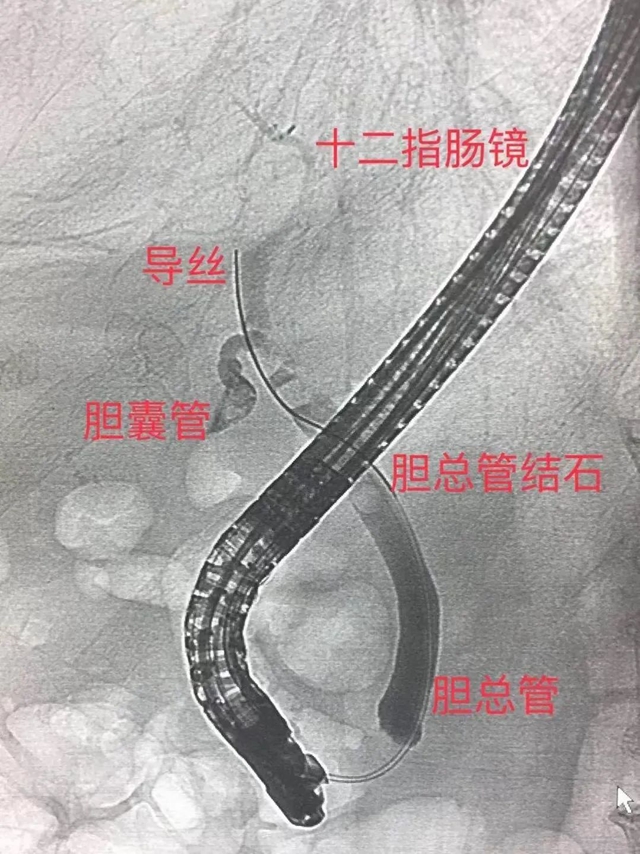 【惊呆】 泸州70岁嬢嬢口中取结石(图3) 3.jpg