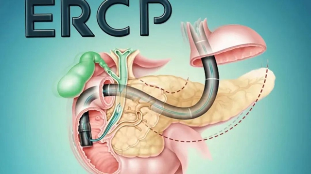 【惊呆】 泸州70岁嬢嬢口中取结石(图4) 4.jpg