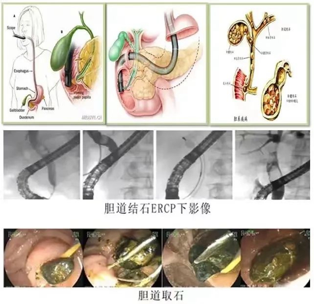 【惊呆】 泸州70岁嬢嬢口中取结石(图5) 5.jpg