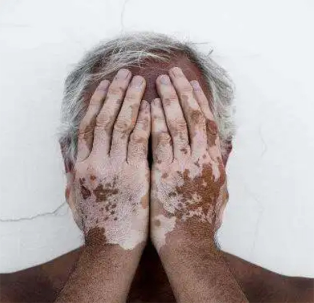 【关注】得了白癜风，可以这样治疗！