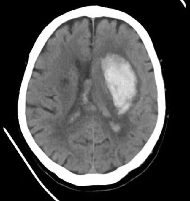 89岁新冠阳性患者突发脑出血 微创手术后转危为安(图3) 3.jpg