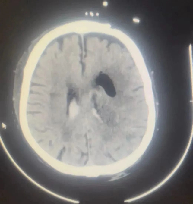89岁新冠阳性患者突发脑出血 微创手术后转危为安(图4) 4.jpg