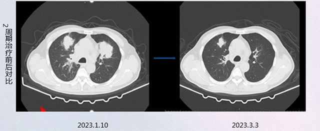 肺癌患者放弃治疗,结果......(图2) 2.jpg