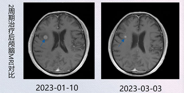 肺癌患者放弃治疗,结果......(图3) 3.jpg