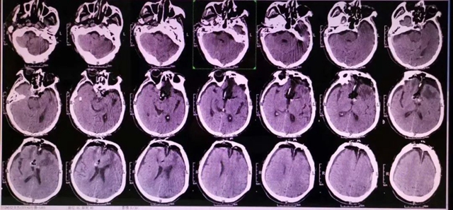 【硬核】16名“开脑壳”的医生啥样?(图3) 3.jpg