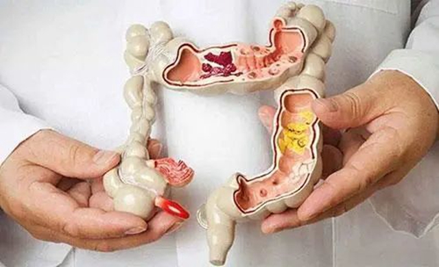 【关注】大便出现这几种情况，小心是癌……