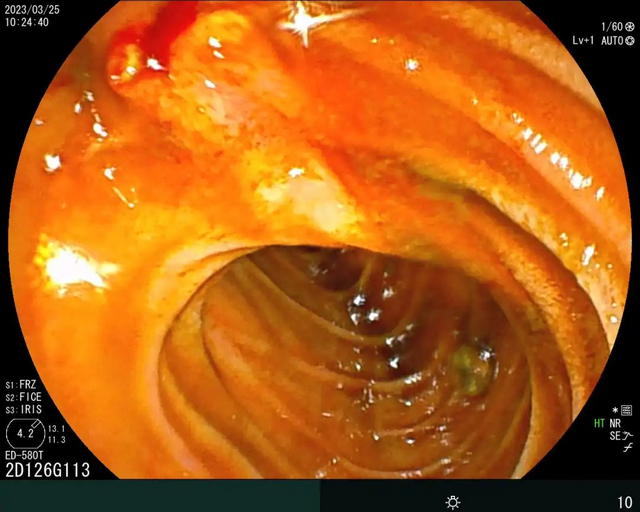 【扩散】不开刀就可以取结石？