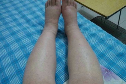 【注意】身上一按一个坑,很多人忽略这个病……(图3) 3.png