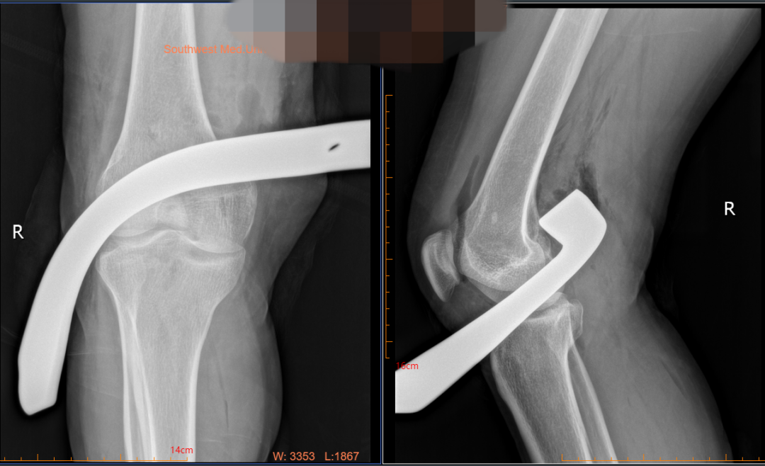 【警惕】吓人!泸州女子右腿被30cm刀片扎穿……(图5) 5.png