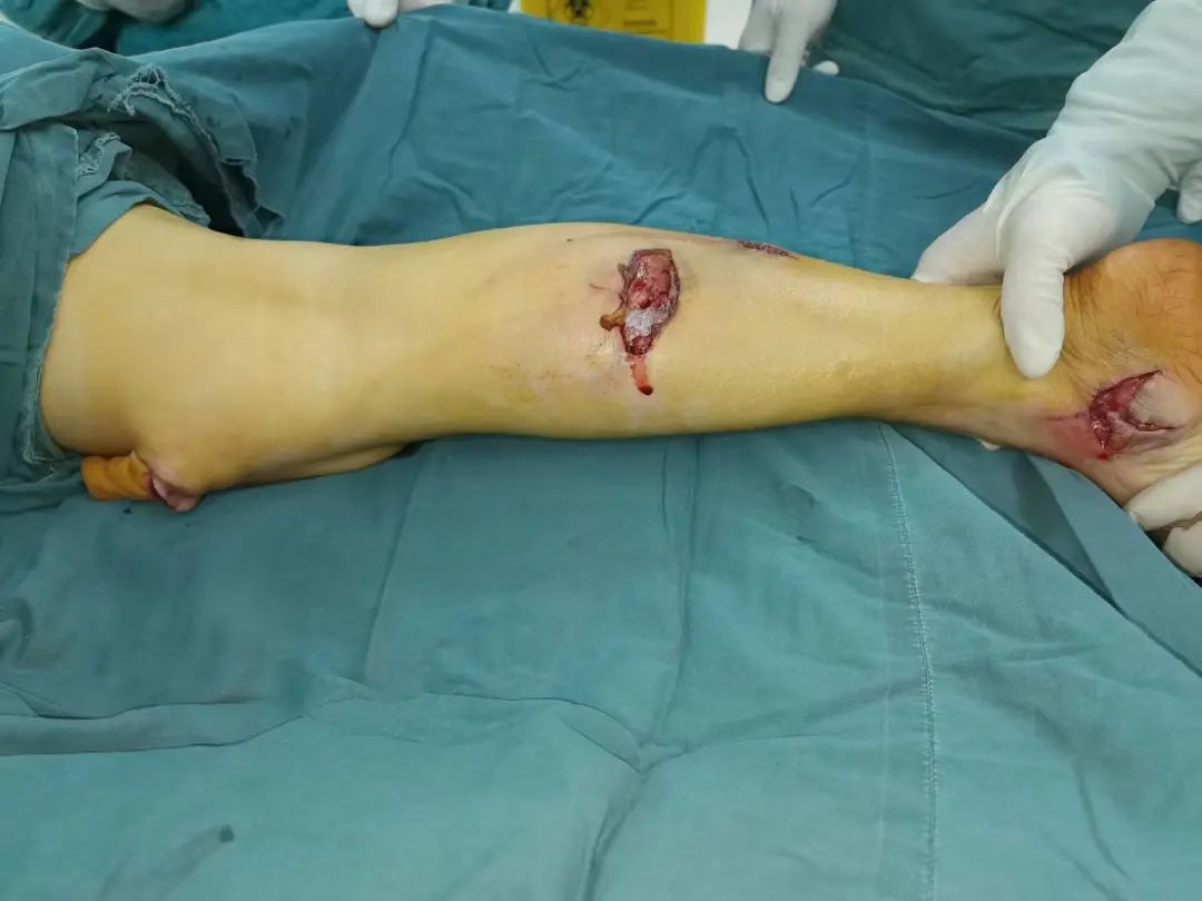 【警惕】吓人!泸州女子右腿被30cm刀片扎穿……(图8) 8.jpg