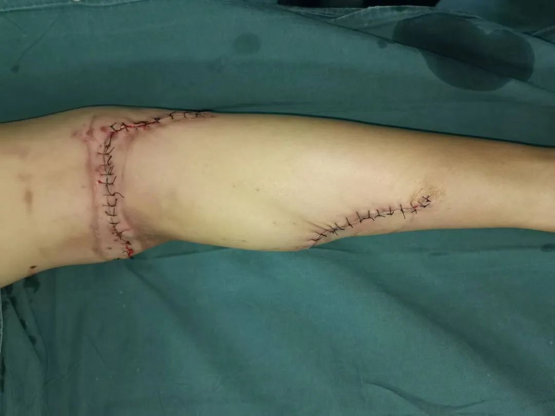 【警惕】吓人!泸州女子右腿被30cm刀片扎穿……(图9) 9.jpg