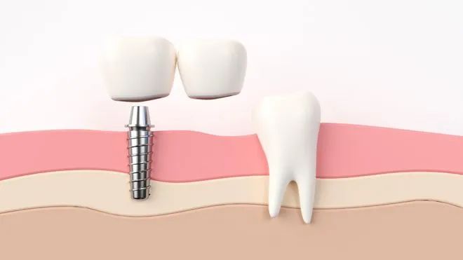 西南医大中医院 口腔种植医疗费用正式下调!(图2) 2.jpg