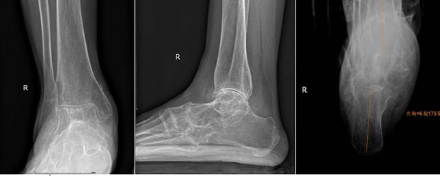 西南医大中医院成功开展川南首例全踝关节置换术