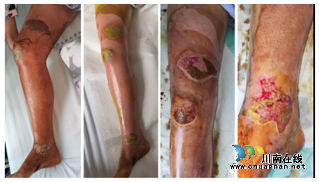 煮沸的鸡汤被打翻！泸州嬢嬢这回烫得……