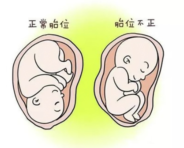 【展绝技】仅一分钟,医生隔肚皮徒手扭转胎位不正(图3) 3.jpg