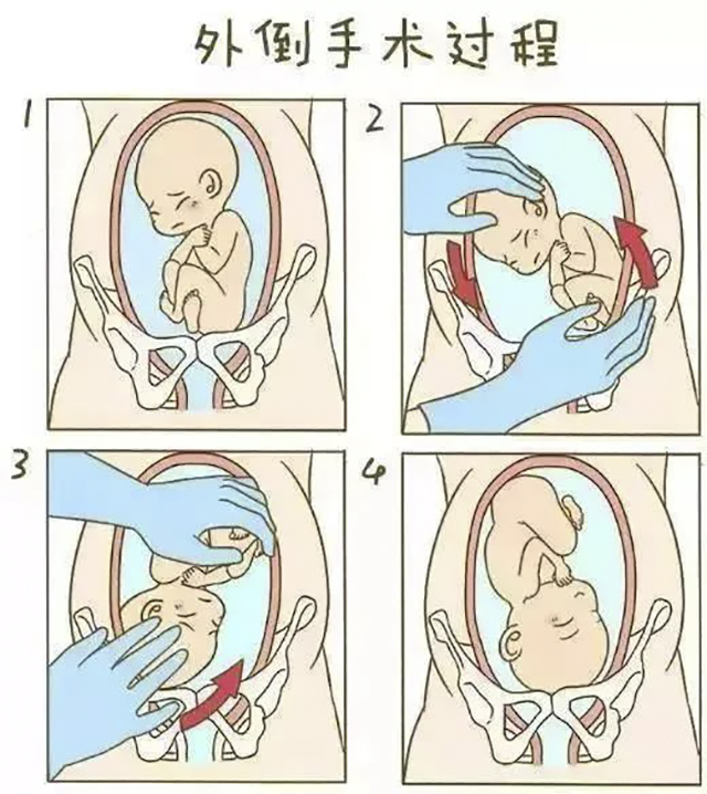 【展绝技】仅一分钟,医生隔肚皮徒手扭转胎位不正(图5) 5.jpg