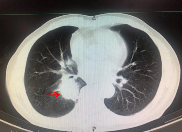 【扩散】9年时间，肿瘤复发后确诊晚期肺癌，至今却……