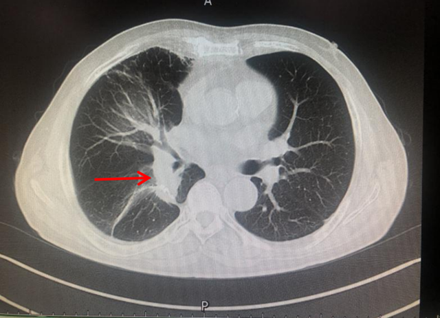 【扩散】9年时间,肿瘤复发后确诊晚期肺癌,至今却……(图2) 微信图片_20230607113524.png