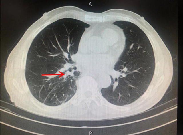 【扩散】9年时间,肿瘤复发后确诊晚期肺癌,至今却……(图3) 微信图片_20230607113530.png