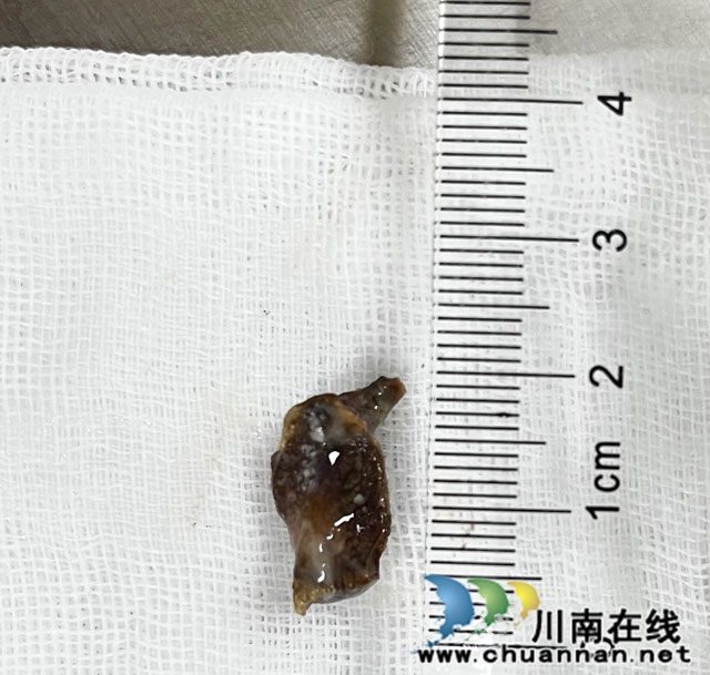 【围观】骨头卡气管，一年后才发现……