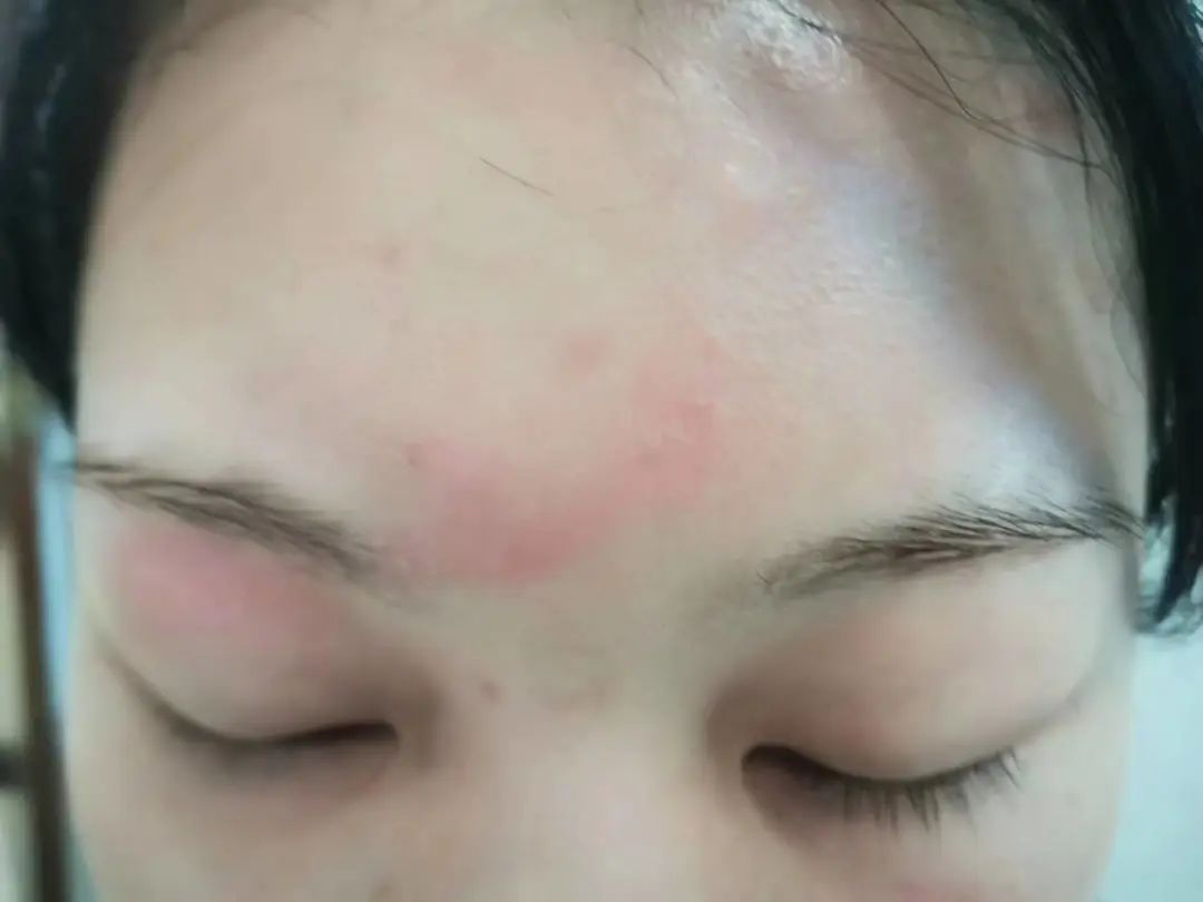 【围观】泸州女子差点毁容,竟是被虫子“泼硫酸”......(图1) 1.jpg