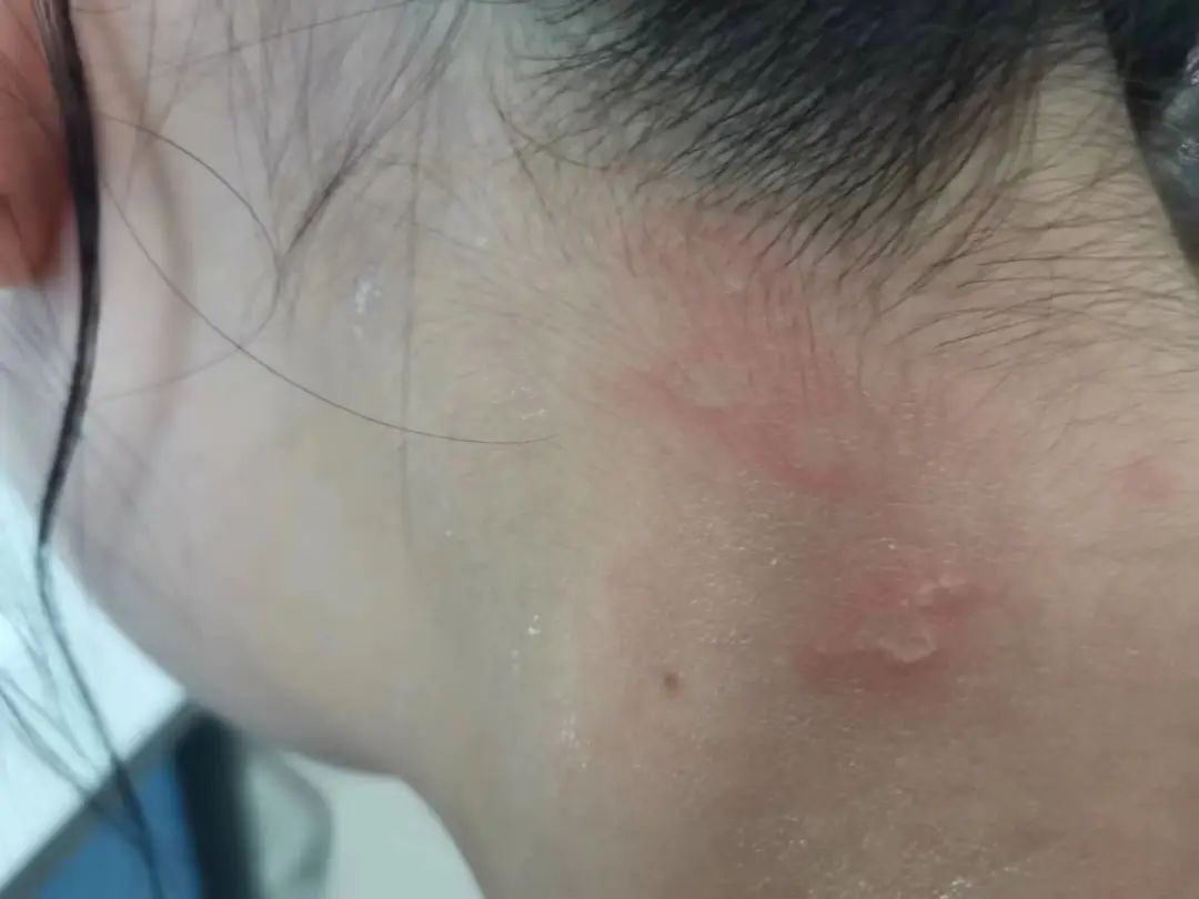 【围观】泸州女子差点毁容,竟是被虫子“泼硫酸”......(图2) 2.jpg