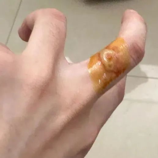 【围观】泸州女子差点毁容,竟是被虫子“泼硫酸”......(图9) 9.jpg