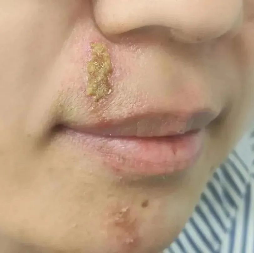 【围观】泸州女子差点毁容,竟是被虫子“泼硫酸”......(图8) 8.jpg