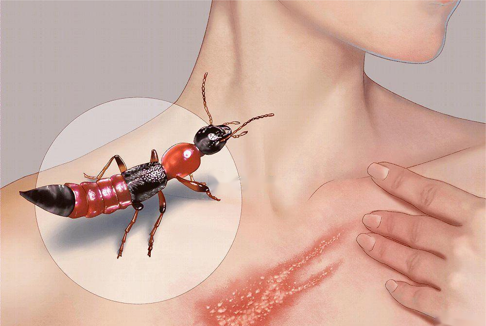 【围观】泸州女子差点毁容,竟是被虫子“泼硫酸”......(图3) 3.png