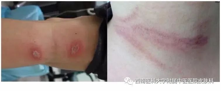 【围观】泸州女子差点毁容,竟是被虫子“泼硫酸”......(图7) 7.jpg