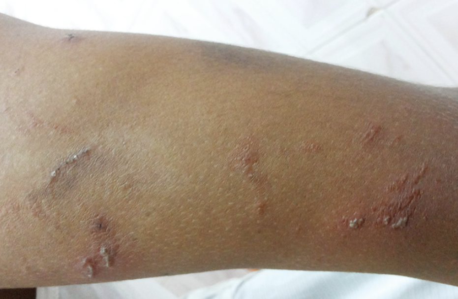 【围观】泸州女子差点毁容,竟是被虫子“泼硫酸”......(图10) 10.png