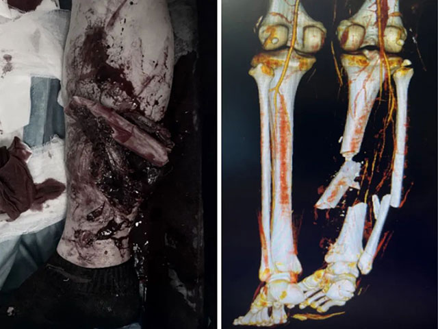 【围观】泸州19岁“摩托”小哥飙车，遭的惨