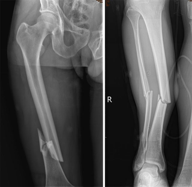 【围观】大腿、小腿3根骨头摔得“稀巴烂”