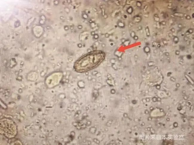 【警惕】连续几天查出肝吸虫卵，医生提醒：这种食物少吃！