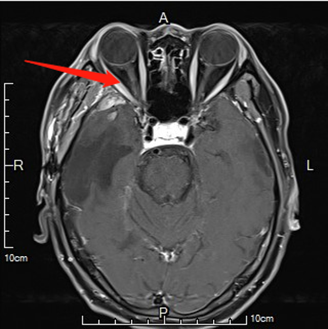 【关注】男子差点摘除眼球,竟因……(图2) 微信图片_20230901092221_1.png